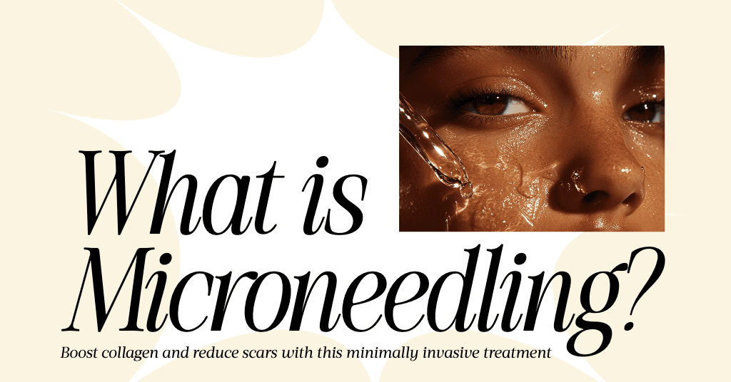 Discover Microneedling: Unique Facebook Ad in Beige